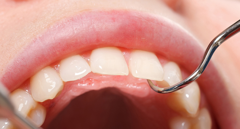 歯科検診の重要性